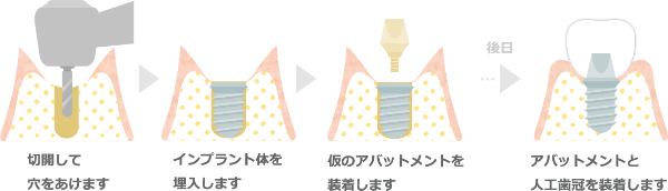 MYデンタルクリニックインプラント