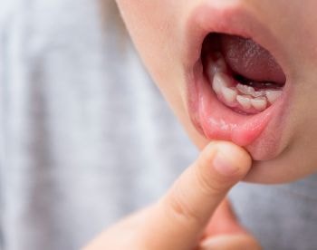 ＭＹデンタルクリニック/虫歯治療