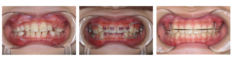 MYデンタル小児矯正