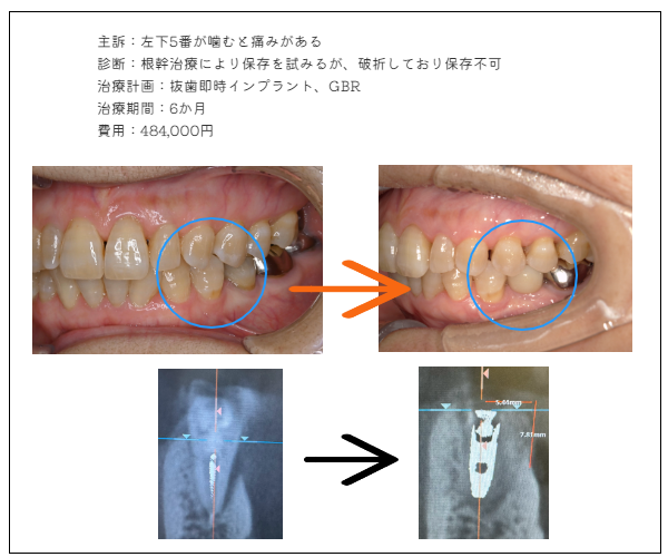 ＭＹデンタルインプラント
