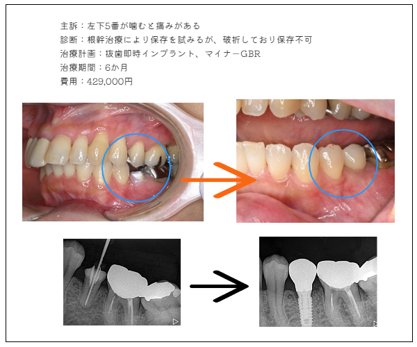 ＭＹデンタルインプラント