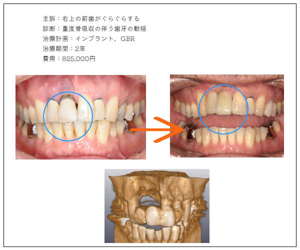 ＭＹデンタルインプラント