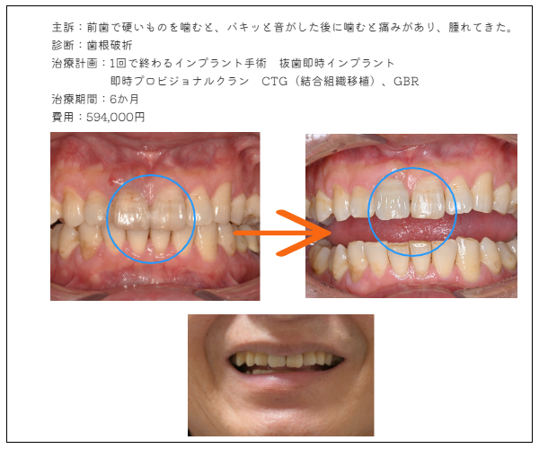ＭＹデンタルインプラント